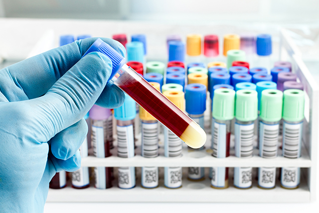 Hand Of A Lab Technician Holding Blood Tube Test And Background A Rack Of Color Tubes With Blood Samples Other Patients / Laboratory Technician Holding A Blood Tube Test